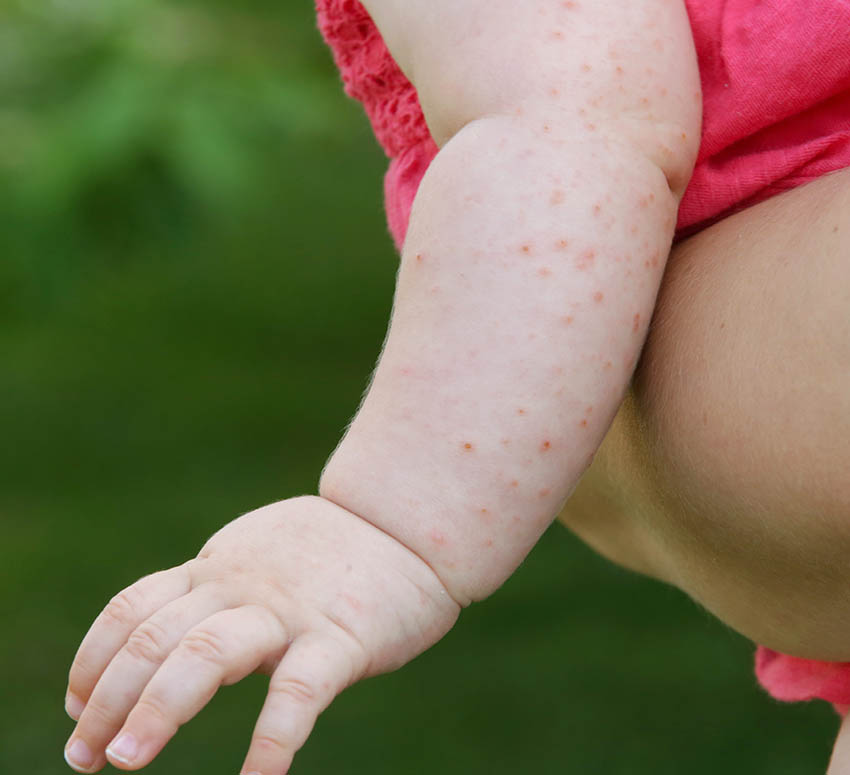 How to Deal With Different Types of Baby Heat Rashes